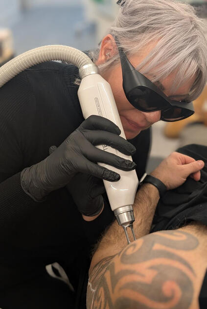 tattoo removal